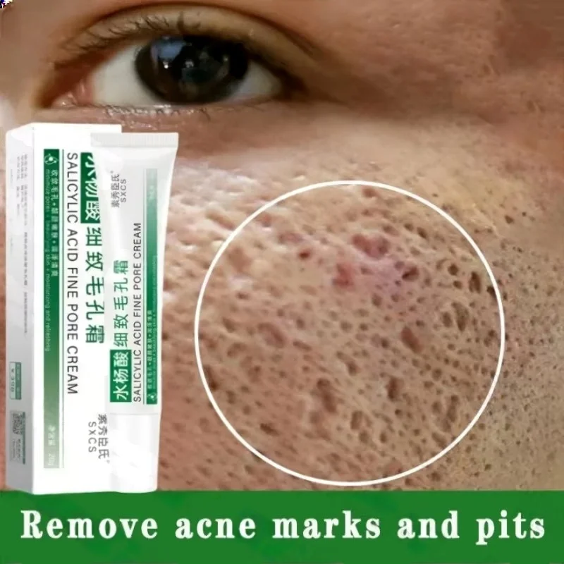 حمض الساليسيليك كريم إزالة الم - مراجعة Azelaic Acid Cream وسعره