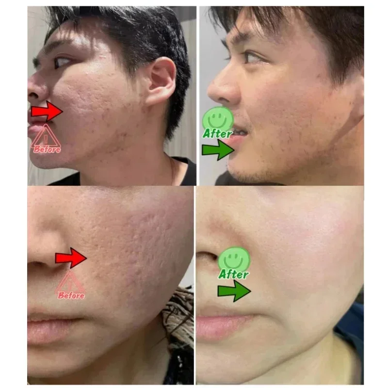 حمض الساليسيليك كريم إزالة الم - مراجعة Azelaic Acid Cream وسعره