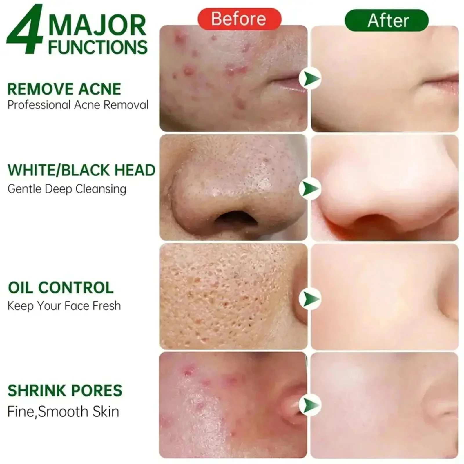 حمض الساليسيليك كريم إزالة الم - مراجعة Azelaic Acid Cream وسعره